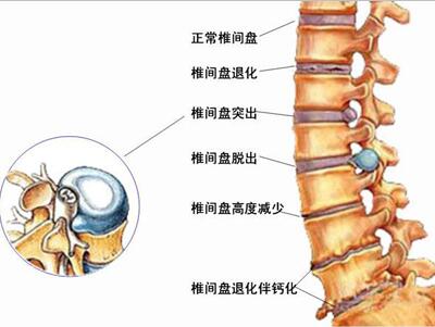 腰椎間盤突出圖片大全