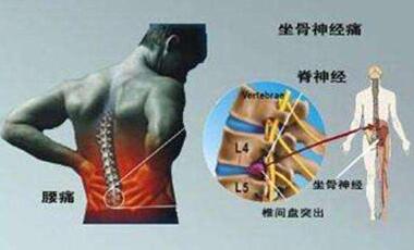 腰椎間盤突出治療方法有哪些