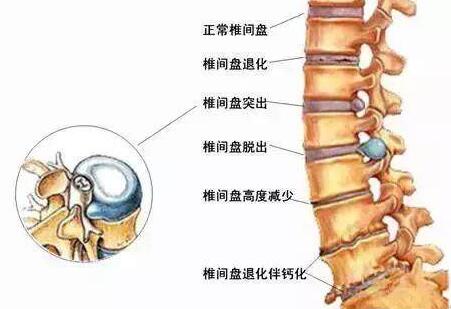 腰椎間盤(pán)突出：三個(gè)要點(diǎn)看懂就能恢復(fù)一半！有時(shí)候是不能按摩的