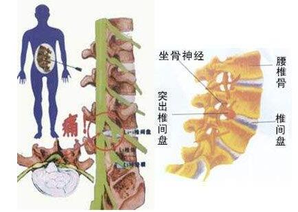 一個(gè)百歲老人留下的祖?zhèn)髌?去除腰間盤(pán)突出疼痛,還您一身輕松