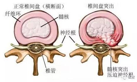 腰椎間盤突出能不能徹底治好？我們看看老中醫(yī)的回答