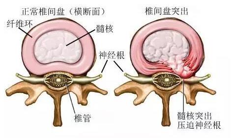 腰椎間盤突出自我療法 練一周就能見(jiàn)效