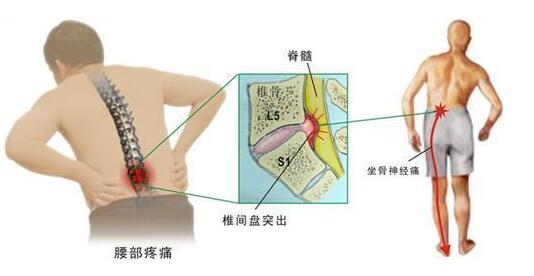 康復(fù)功能鍛煉：腰椎間盤突出，最好的大夫是自己，堅持十天見效