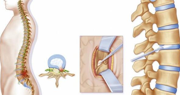 椎間盤突出到底指什么