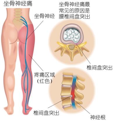 得了腰椎間盤突出吃什么藥能治好