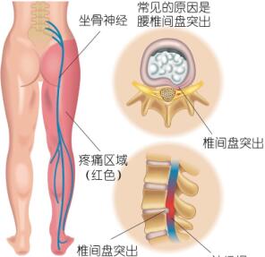 得了腰椎間盤突出吃什么藥能治好