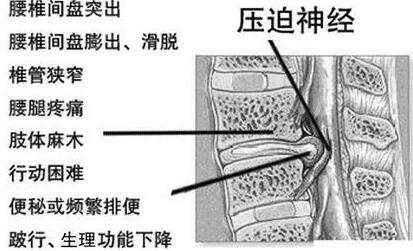 治好腰椎間盤突出中醫(yī)，一味中藥治好它！