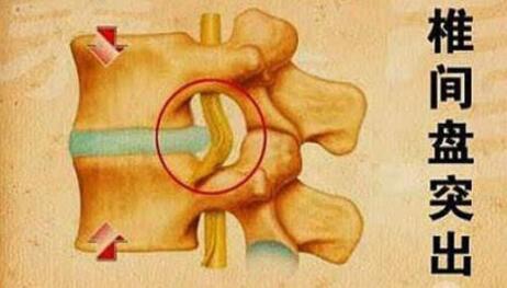 老中醫(yī)只用3味草藥治愈多年間盤突出,不復發(fā)