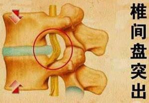 老中醫(yī)只用3味中草藥治愈多年腰間盤突出,不復(fù)發(fā)