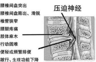 早期腰間盤突出癥狀有哪些？