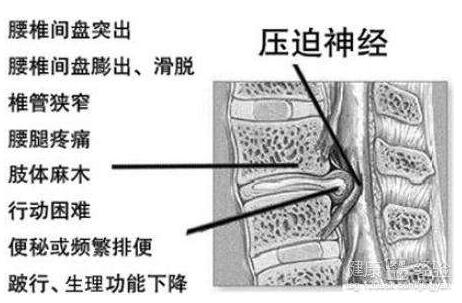 早期腰間盤突出癥狀有哪些？