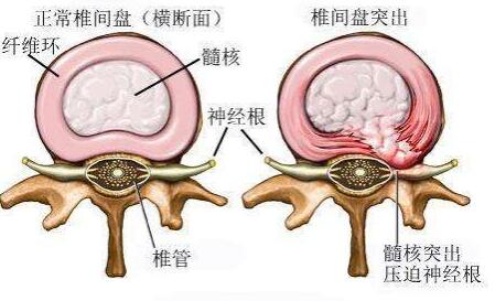 椎間盤突出結(jié)構(gòu)圖