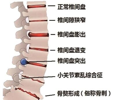 椎間盤突出結(jié)構(gòu)圖