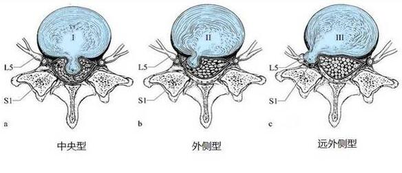 椎間盤突出橫切面圖