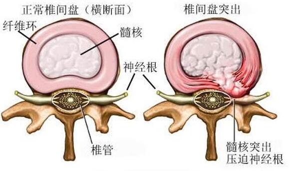椎間盤突出橫切面圖