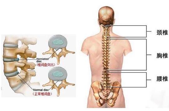 腰椎間盤突出骨骼圖