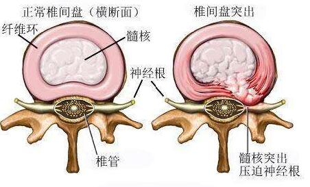 椎間盤突出結(jié)構(gòu)圖