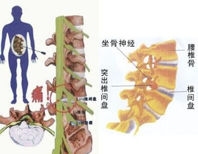 腰椎間盤突出骨骼圖