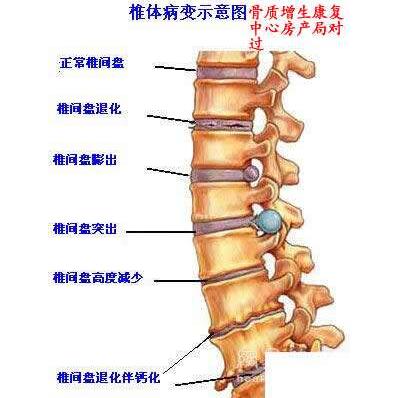 腰椎間盤突出骨骼圖