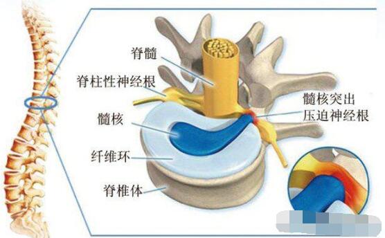 腰椎間盤突出骨骼圖