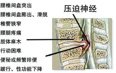 腰椎間盤(pán)突出骨骼圖