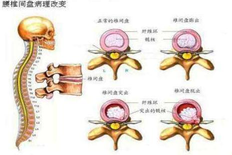 椎間盤(pán)突出結(jié)構(gòu)圖