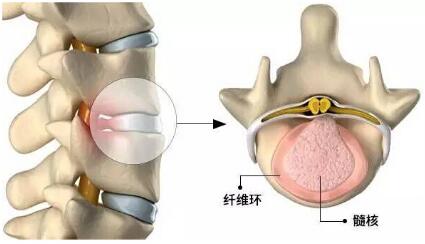 椎間盤突出結(jié)構(gòu)圖