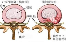 椎間盤突出橫切面圖