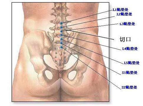 腰椎骨腰椎4—5節(jié)位置圖片