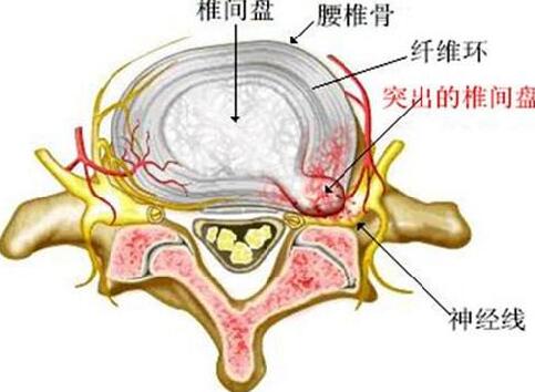 椎間盤突出橫切面圖