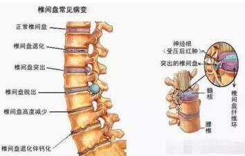 腰椎間盤突出骨骼圖