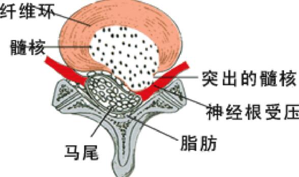 椎間盤突出結(jié)構(gòu)圖