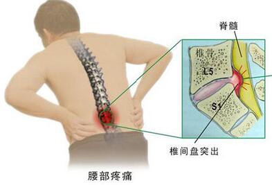 腰椎間盤突出骨骼圖