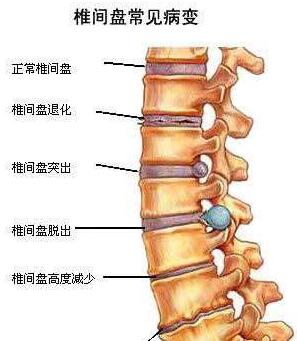 椎間盤突出結(jié)構(gòu)圖