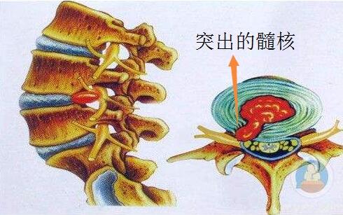 椎間盤突出橫切面圖