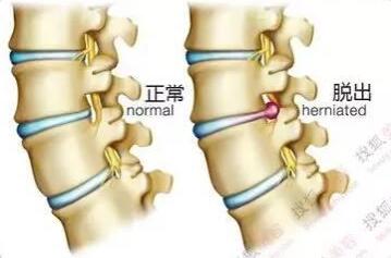 椎間盤突出結構圖