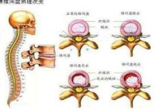 椎間盤突出結(jié)構(gòu)圖