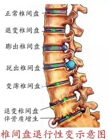 椎間盤突出結(jié)構(gòu)圖