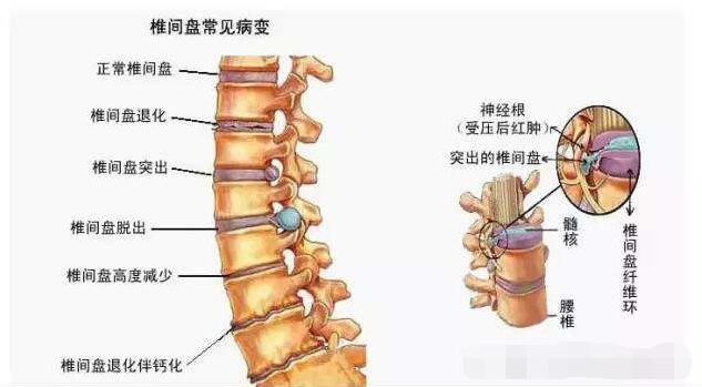 腰椎間盤突出骨骼圖