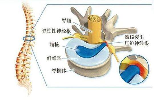 椎間盤突出結(jié)構(gòu)圖