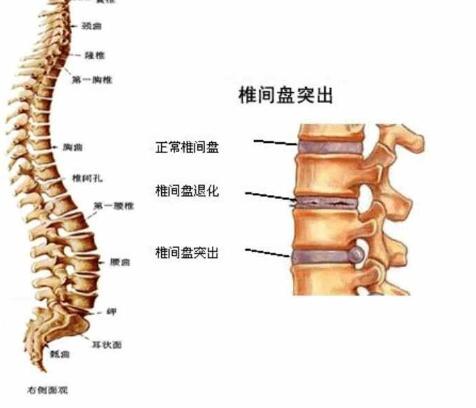 腰椎間盤突出骨骼圖