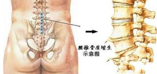 腰椎間盤突出的具體病因是什么