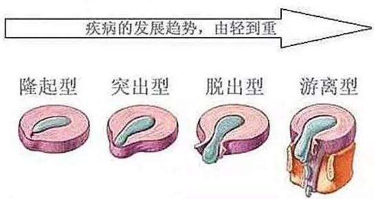 腰椎間盤突出的病理形態(tài)