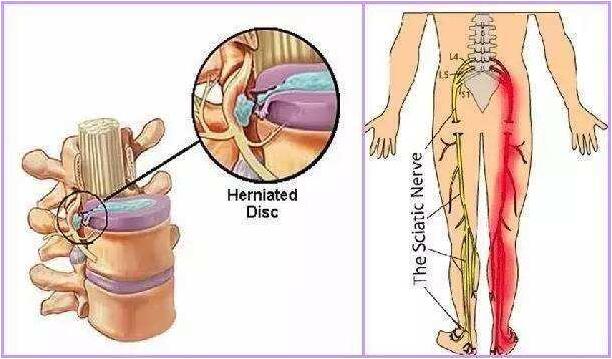 腰椎間盤突出癥的鑒別診斷