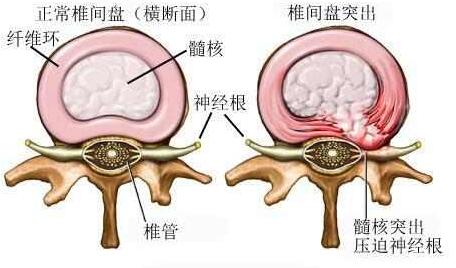 腰椎間盤突出