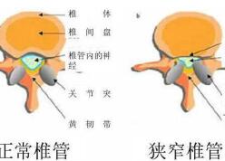 腰椎間盤突出癥鑒別診斷