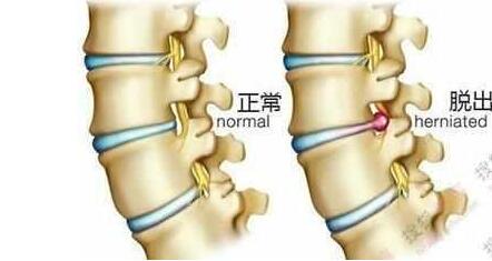 腰椎間盤突出