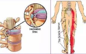 腰椎間盤突出癥的鑒別診斷