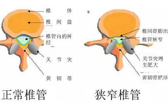 腰椎管狹窄癥