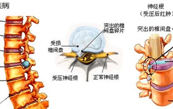 腰椎間盤突出癥鑒別診斷